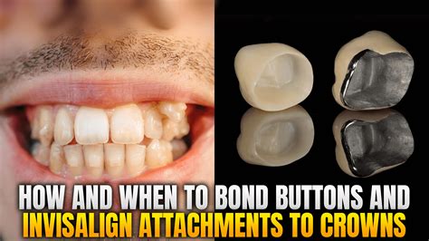 can you bond bracket to metal band|Bonding Buttons and Attachments to Crowns: What .